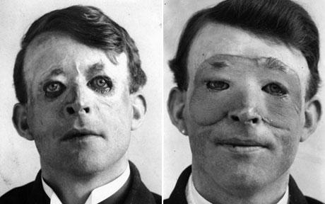 Walter Yeo 1917 surgery ref link : https://en.wikipedia.org/wiki/Plastic_surgery#/media/File:Walter_Yeo_skin_graft.jpg