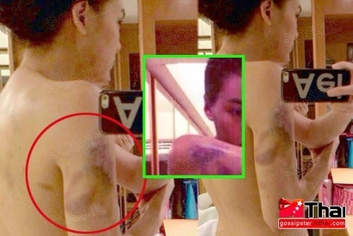 image of ภาพหลุดคล้าย "เจนี่" โดนซ้อม!! โชว์รอยแผล ช้ำทั้งตัว