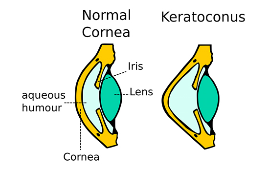 Keratoconus