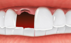 Wisdom Tooth Extraction Toronto