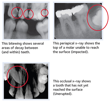 Wisdom Tooth Extraction Toronto