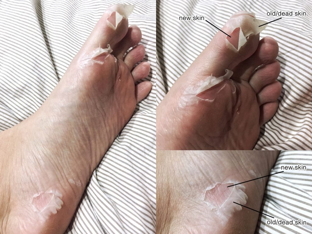 7. Although I expected the peeling to start within 5-7 days as claimed, my feet was noticeably peeling (left sole) by the third day instead. And it's still continuing currently.