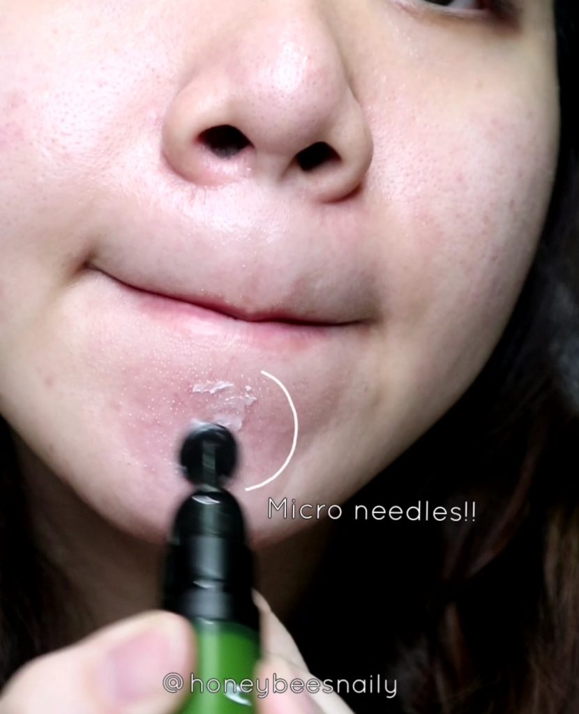 micro needle spot cream