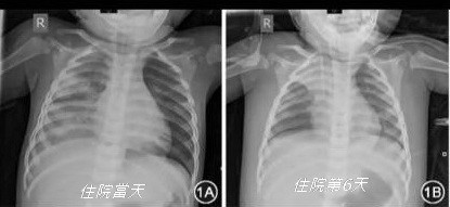 牛牛入院後第6天胸腔明顯縮小、右上葉肺不張。