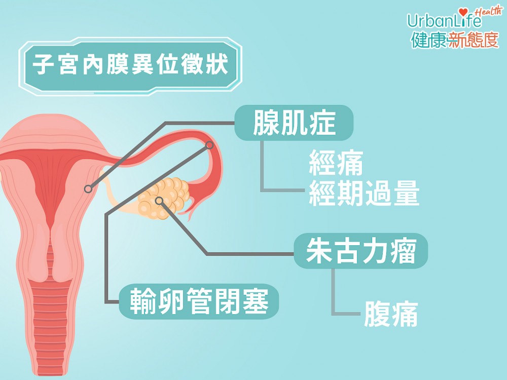 當子宮內膜脫離子宮最內層,出現於卵巢位置,就會形成我們俗稱的「朱古力瘤」。