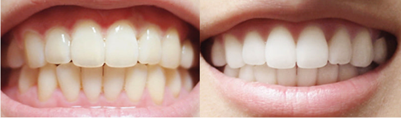 Haring B Gel trắng răng cấp tốc Teeth Whitening Gel 3g Haring B Gel trắng răng cấp tốc Teeth Whitening Gel 3g
