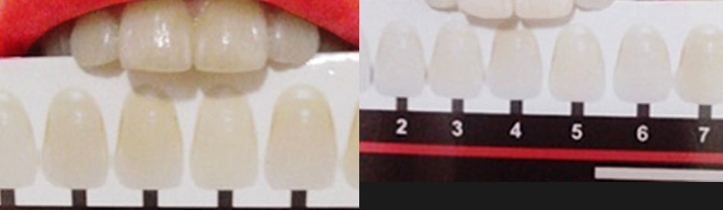 Haring B Gel trắng răng cấp tốc Teeth Whitening Gel 3g Haring B Gel trắng răng cấp tốc Teeth Whitening Gel 3g