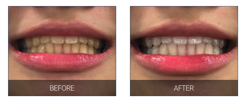 Haring B Gel trắng răng cấp tốc Teeth Whitening Gel 3g Haring B Gel trắng răng cấp tốc Teeth Whitening Gel 3g