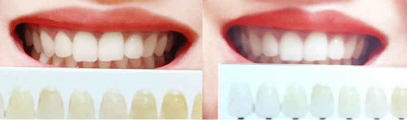 Haring B Gel trắng răng cấp tốc Teeth Whitening Gel 3g Haring B Gel trắng răng cấp tốc Teeth Whitening Gel 3g
