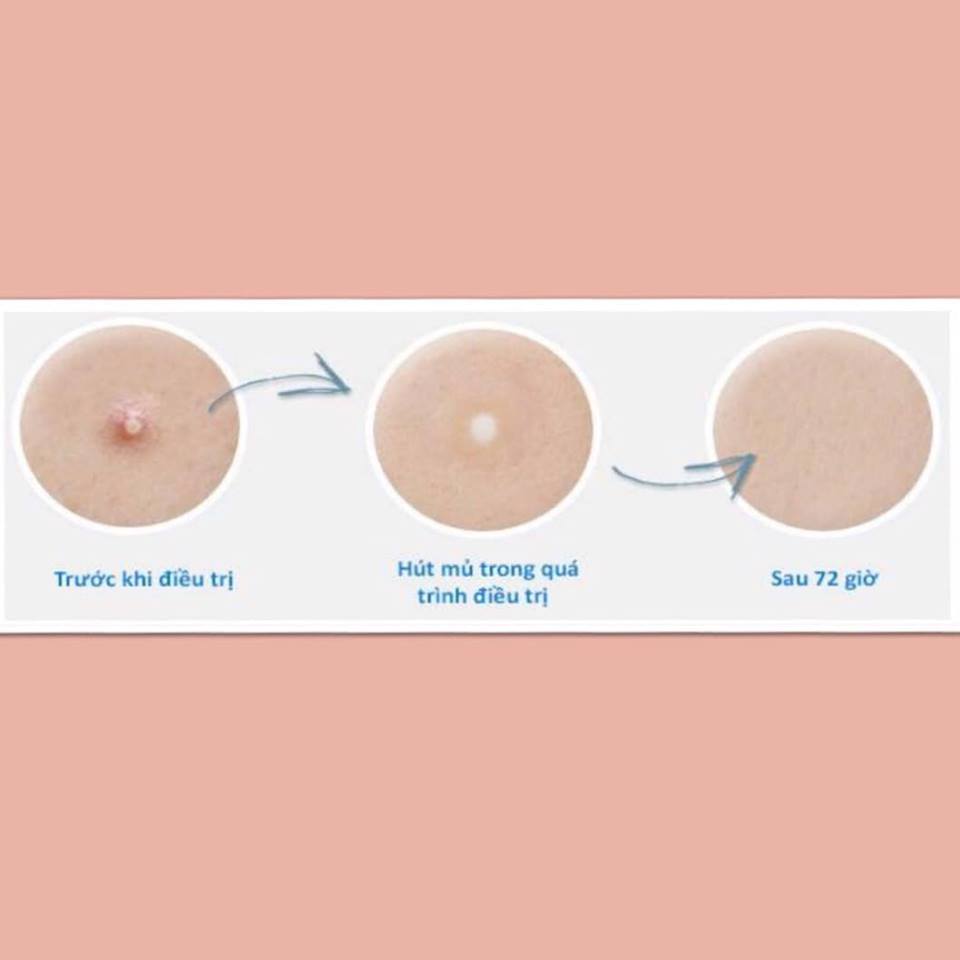 Medifoam Dán trị mụn H Beauty 42p Medifoam Dán trị mụn H Beauty 42p