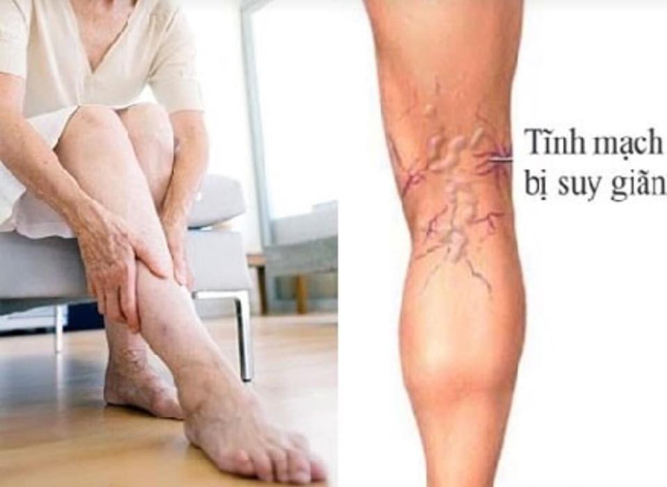 Dongkook Thuốc giảm giãn tĩnh mạch Sensia 100p Dongkook Thuốc giảm giãn tĩnh mạch Sensia 100p