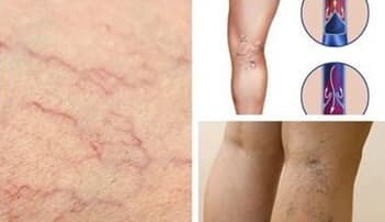 Dongkook Thuốc giảm giãn tĩnh mạch Sensia 100p Dongkook Thuốc giảm giãn tĩnh mạch Sensia 100p