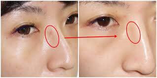 Donga Thuốc trị sẹo, thâm mụn Noscarna Gel 10g Donga Thuốc trị sẹo, thâm mụn Noscarna Gel 10g