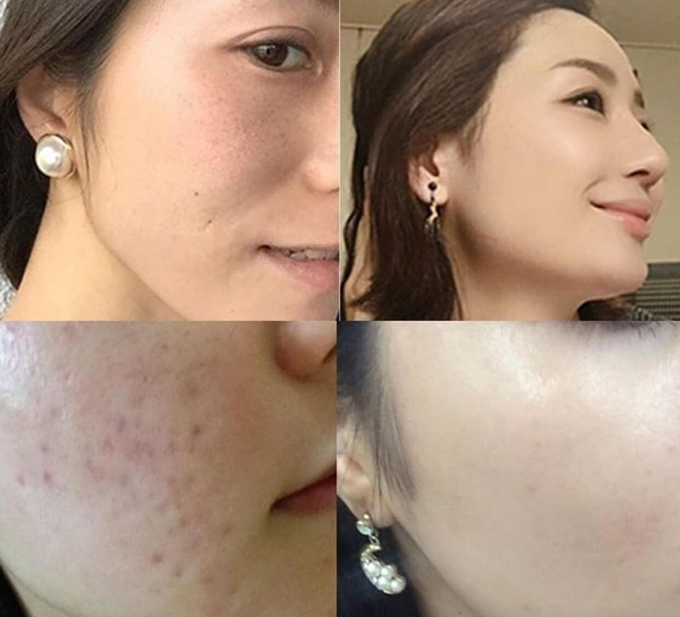 Tisha Tinh Chất Gai Biển T2 Serum MTS 30ml Tisha Tinh Chất Gai Biển T2 Serum MTS 30ml