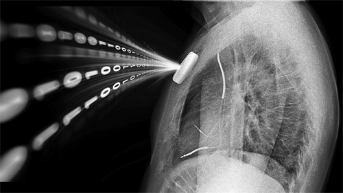 IIT Kharagpur working on developing battery-free implantable medical devices IIT Kharagpur working on developing battery-free implantable medical devices