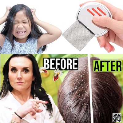 Picture of Stainless Steel Lice Removal Comb