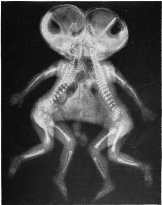 An X-ray of Siamese twins.