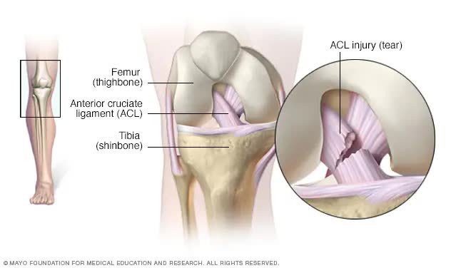 Dây chằng chéo trước ACL thật sự rất mỏng manh như một cọng dây thun nhỏ.