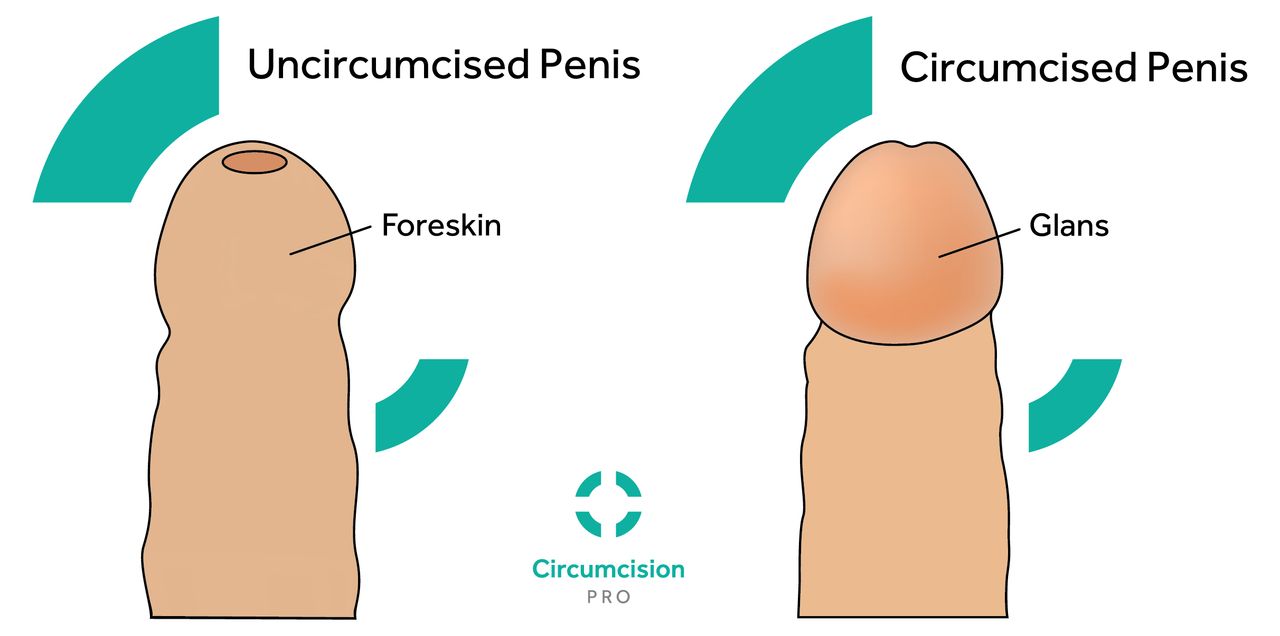 Nguồn ảnh: Circumcision Pro: Cắt bao quy đầu và không cắt bao quy đầu