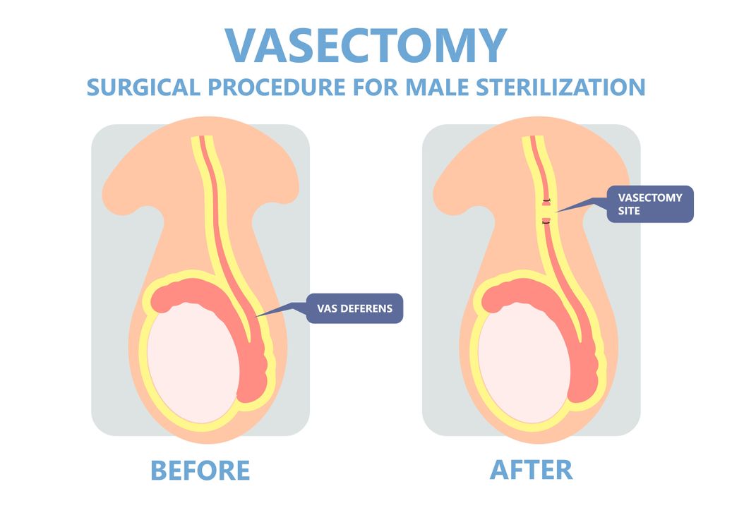 Nguồn ảnh: Vasectomy ie: Triệt sản ở nam giới – Thắt ống dẫn tinh