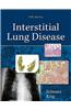 Interstitial Lung Disease