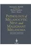 Pathology of Melanocytic Nevi and Malignant Melanoma