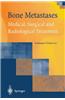 Bone Metastases