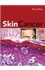 Skin Cancer