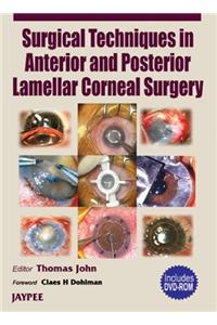 Surgery Technique in Anterior and Post. Lamellar Corneal Surgery