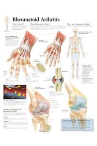 Rheumatoid Arthritis
