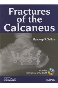 Fractures of the Calcaneus