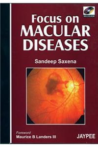 Focus on Macular Diseases