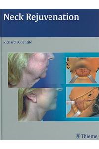 Neck Rejuvenation