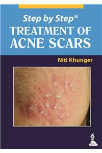 Step by Step Treatment of Acne Scars