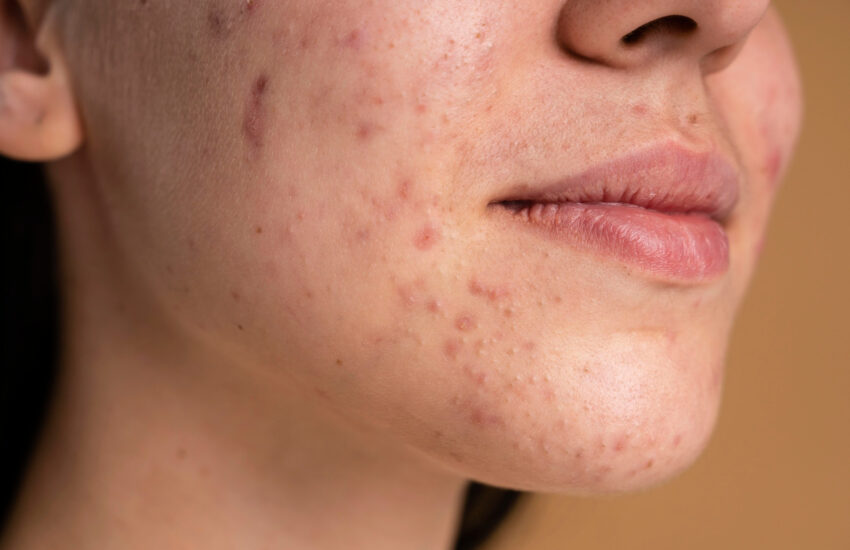 7 Home Remedies For Acne Scars