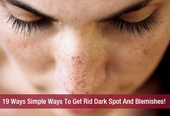 How To Get Rid Of Pigmentation Naturally How To Get Rid Of Pigmentation Naturally