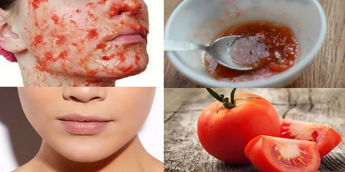 10 Home Remedies to Erase Acne Scars Home Remedies To Remove Acne Scars Effectivelykhoobsurati