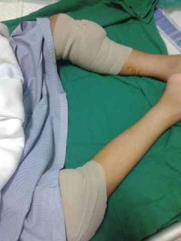 tumor operasi bpjs Kanker  Bantu  Mengobati Tulang Shanty Kitabisa!