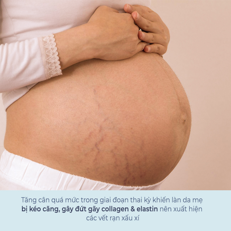 Rạn da khi mang thai do tăng cân quá mức gây ra, dẫn đến sự đứt gãy collagen và elastin, xuất hiện các vết rạn xấu xí trên bụng mẹ. Xem ngay cách khắc phục cùng Lixibox để tự tin hơn.