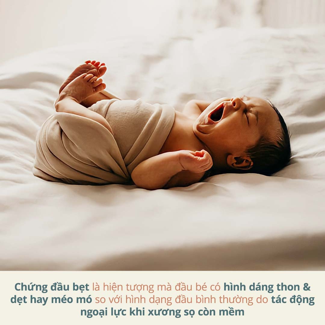 Chứng đầu bẹp là hiện tượng mà đầu bé có hình dáng thon & dẹt hay méo mó so với hình dạng đầu bình thường do tác động ngoại lực khi xương sọ còn mềm. Thay đổi 3 chi tiết nhỏ trong lúc ngủ giúp mẹ an tâm xua tan nỗi lo bẹp đầu ở con yêu.