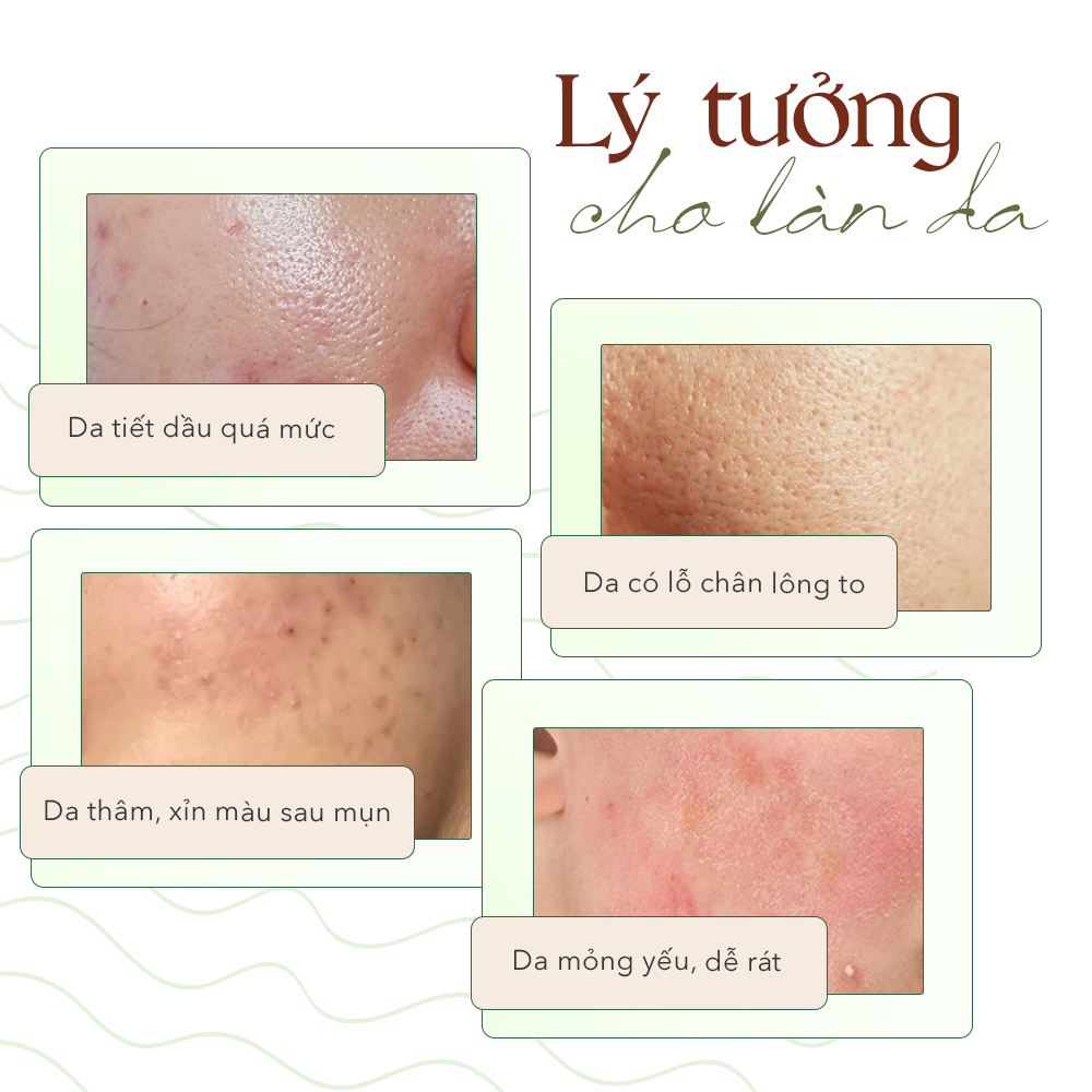 Bốn tình trạng da và giải pháp serum cho da mụn từ The Auragins: da tiết dầu quá mức, da có lỗ chân lông to, da mỏng yếu dễ rát, da thâm, xỉn màu sau mụn; giới thiệu về sản phẩm serum mới ra mắt và công dụng của chúng.