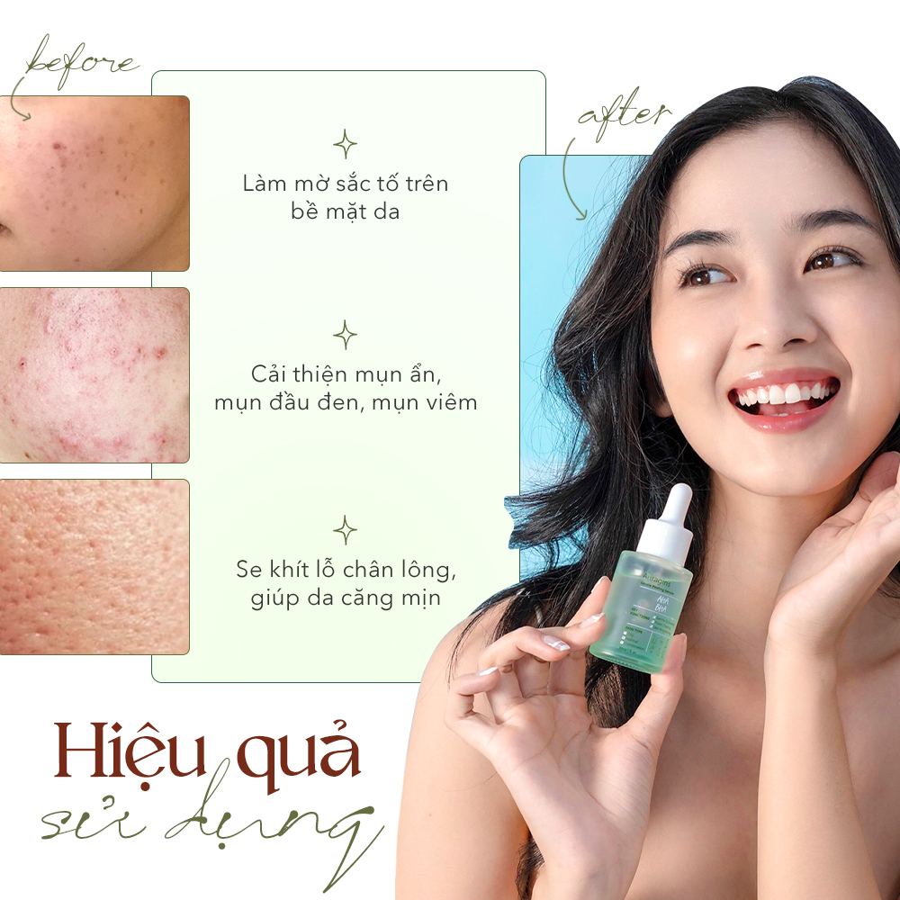 Hình ảnh quảng bá cho 3 dòng serum mới của The Auragins, thể hiện hiệu quả trước và sau khi sử dụng. Serum giúp cải thiện tình trạng da xỉn màu, mụn đầu đen và lỗ chân lông to, mang đến làn da căng mịn và sáng khỏe. Tìm hiểu ngay về serum cho da mụn và tinh chất dưỡng da The Auragins.
