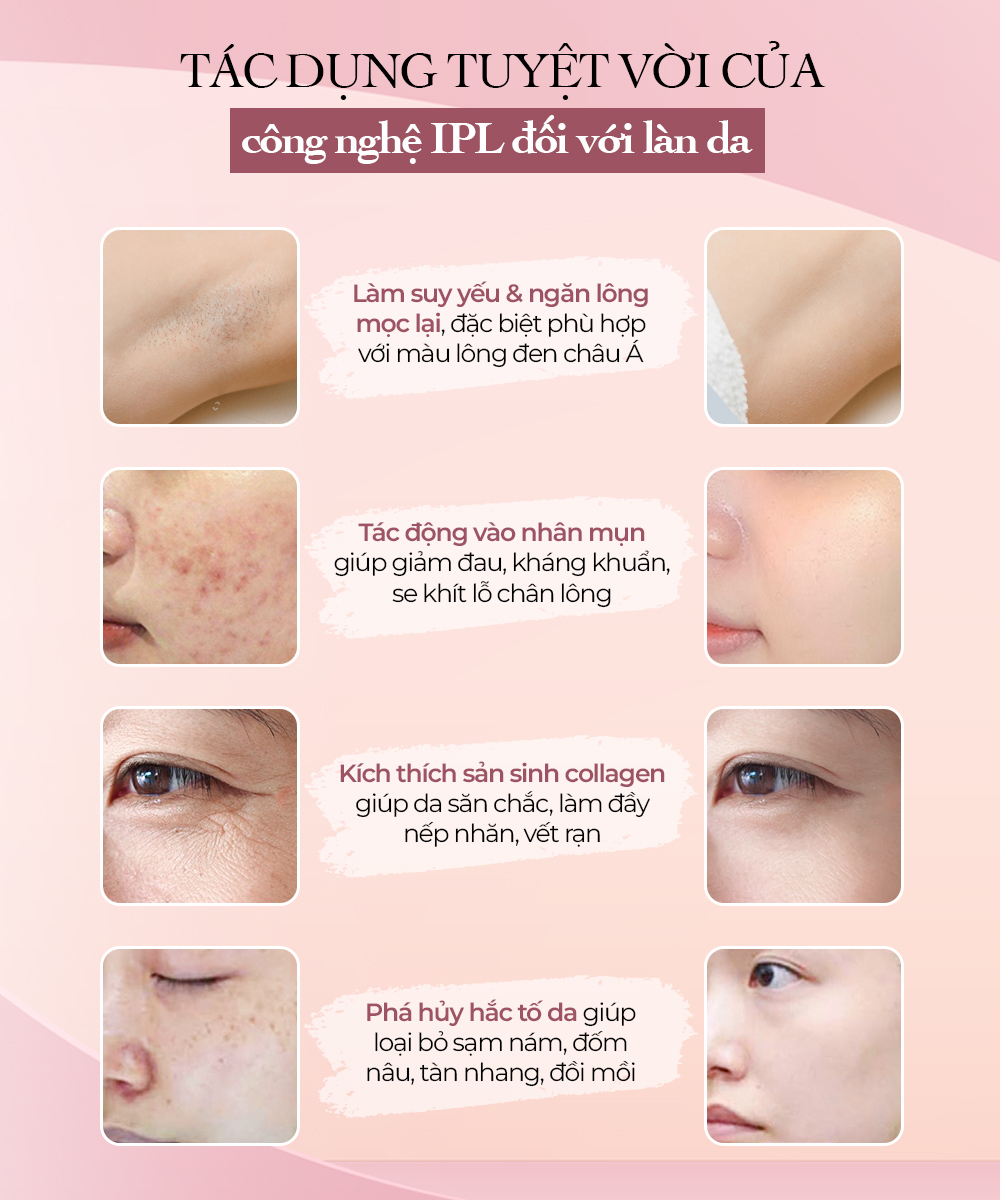 Tác dụng tuyệt vời của công nghệ IPL đối với làn da: làm suy yếu & ngăn lông mọc lại, tác động vào nhân mụn giúp giảm đau, kích thích sản sinh collagen, phá hủy hắc tố da giúp loại bỏ sạm nám.