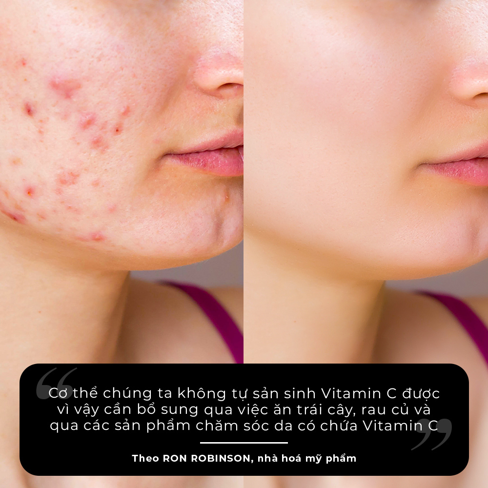 Kết quả trước và sau khi sử dụng Vitamin C cho làn da, thể hiện hiệu quả chống lão hóa và dưỡng sáng da. Dưới hình là trích dẫn của Ron Robinson về tầm quan trọng của việc bổ sung Vitamin C qua thực phẩm và sản phẩm skincare.
