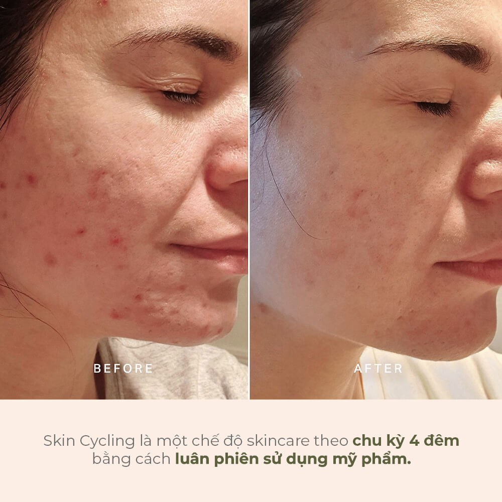 Bức ảnh so sánh làn da trước và sau khi áp dụng phương pháp Skin Cycling, chế độ skincare theo chu kỳ 4 đêm giúp phục hồi da. Xu hướng làm đẹp này đang thu hút sự chú ý trên TikTok với gần 4 tỷ lượt xem.