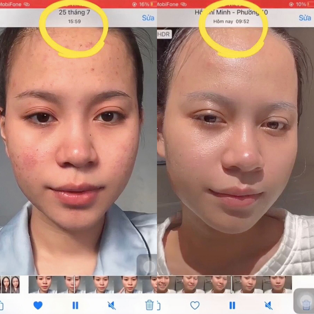 Kết quả sử dụng bộ đôi serum The Auragins trên da với tình trạng da dầu mụn trước và sau, minh họa hiệu quả trong việc giảm bóng dầu và cải thiện lỗ chân lông, phù hợp cho mùa Tết.