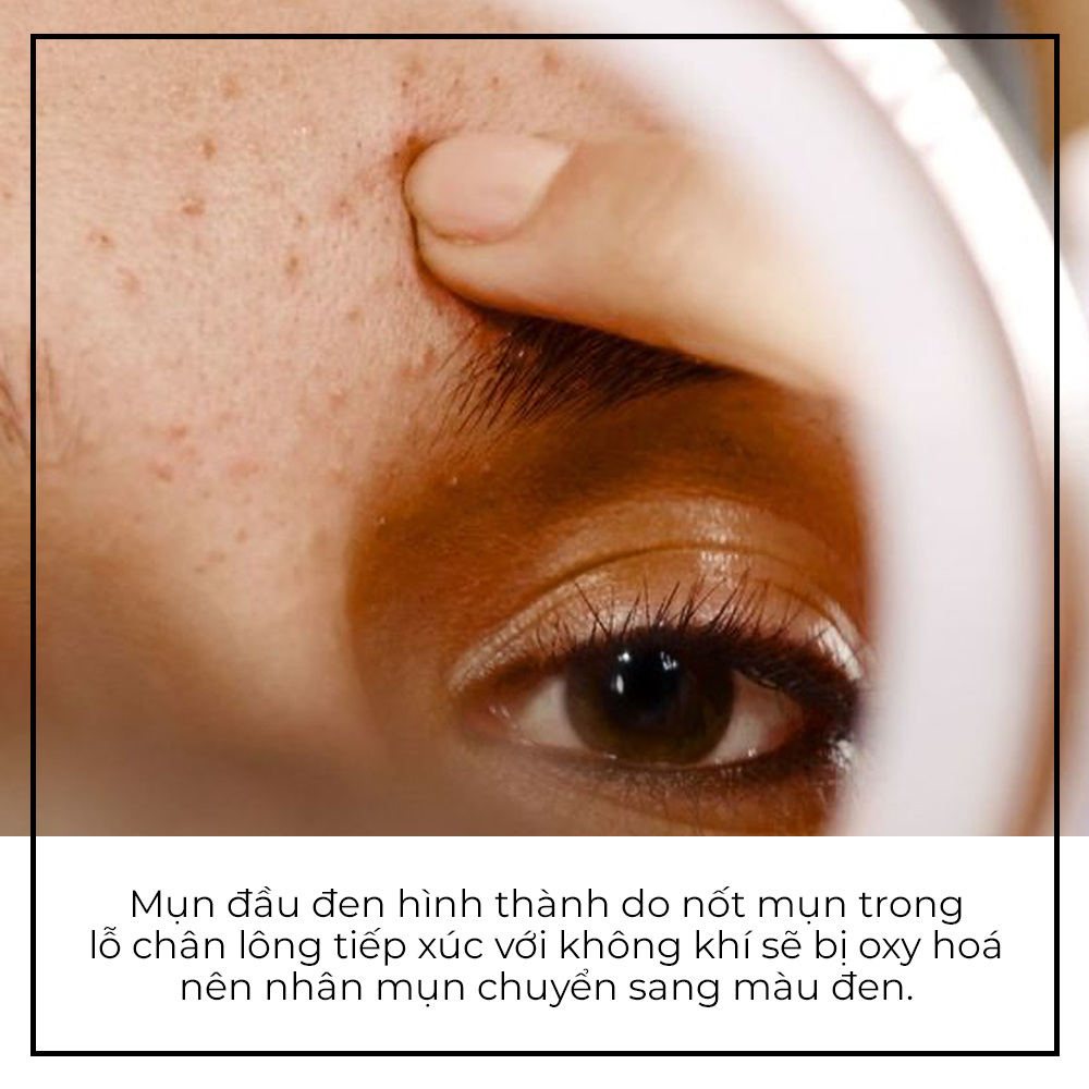 Mụn đầu đen hình thành do nốt mụn trong lỗ chân lông tiếp xúc với không khí sẽ bị oxy hóa nên nhân mụn chuyển sang màu đen. Bài viết trên Lixibox cung cấp thông tin giúp bạn hiểu rõ hơn về lỗ chân lông và cách khắc phục lỗ chân lông to trong skincare.
