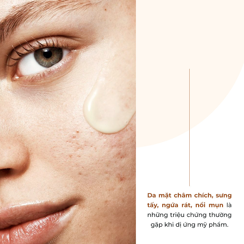 Da mặt châm chích, sưng tấy, ngừa rát, nổi mụn là những triệu chứng thường gặp khi dị ứng mỹ phẩm. Bài viết từ Lixibox sẽ giúp bạn cần làm gì khi da bị dị ứng mỹ phẩm, cùng tìm hiểu cách phục hồi da sau dị ứng.