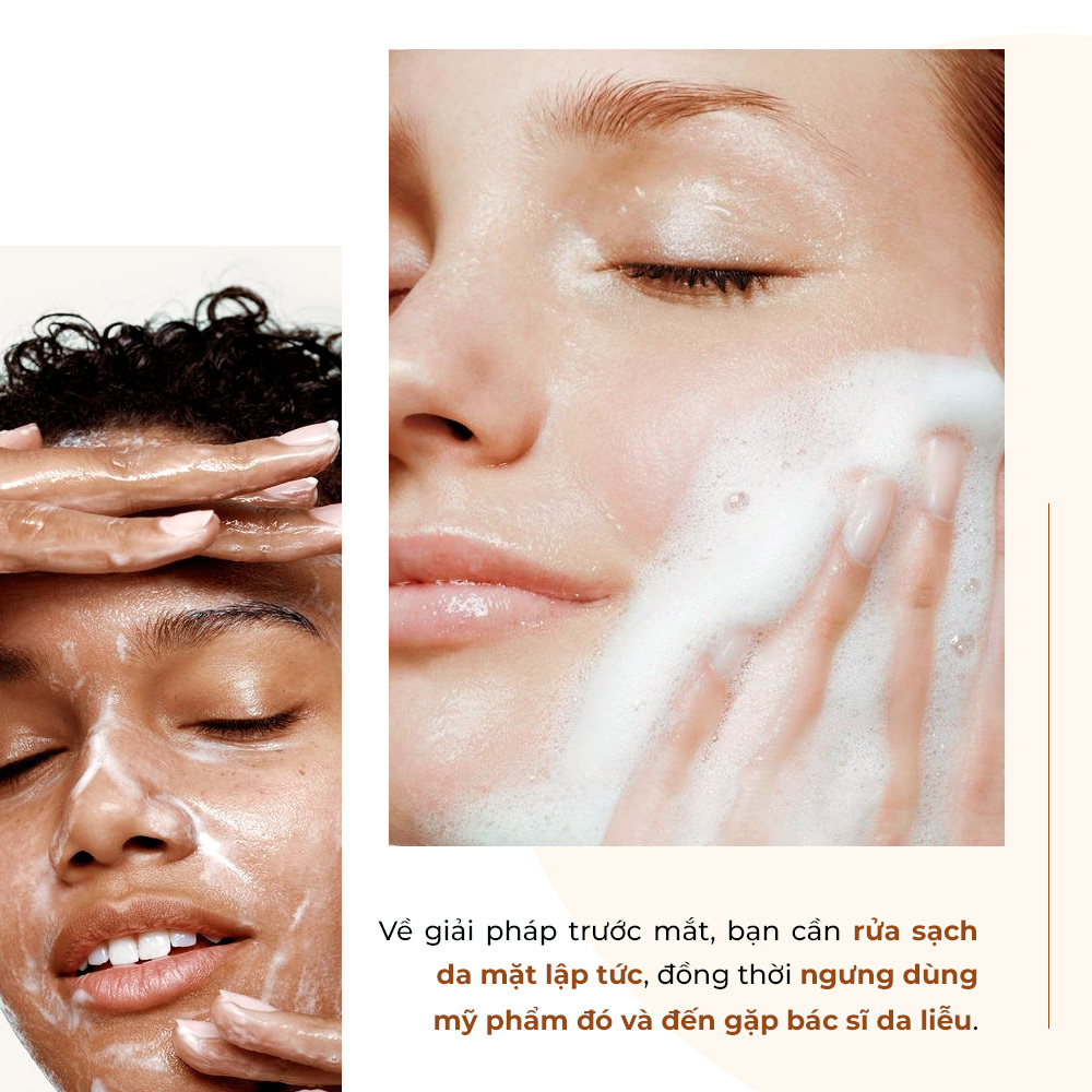 Khi da bị dị ứng mỹ phẩm, điều quan trọng là phải rửa sạch da mặt lập tức và ngừng sử dụng mỹ phẩm có chứa thành phần gây kích ứng. Tìm hiểu thêm về cách phục hồi da sau dị ứng mỹ phẩm và những lưu ý quan trọng để bảo vệ làn da nhạy cảm của bạn.