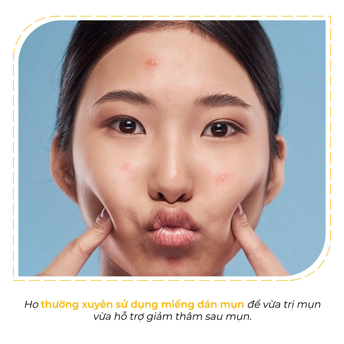 Họ thường xuyên sử dụng miếng dán mụn để vừa trị mụn vừa hỗ trợ giảm thâm sau mụn. Khám phá bí quyết làm đẹp của người Hàn Quốc để có làn da trắng sáng, mịn màng như sứ với Lixibox Skincare.